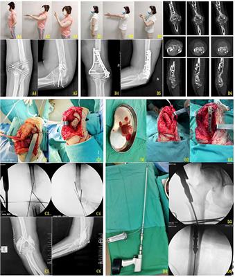 A case report of membrane induction combined with RIA technique for the repair of distal humerus segmentary bone defect